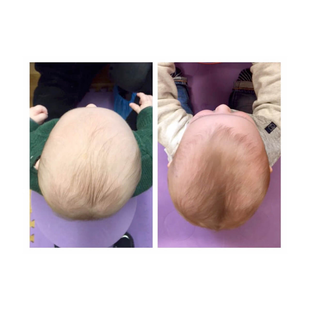 Zaležana glavica prije i poslije upotrebe Mimos jastuka