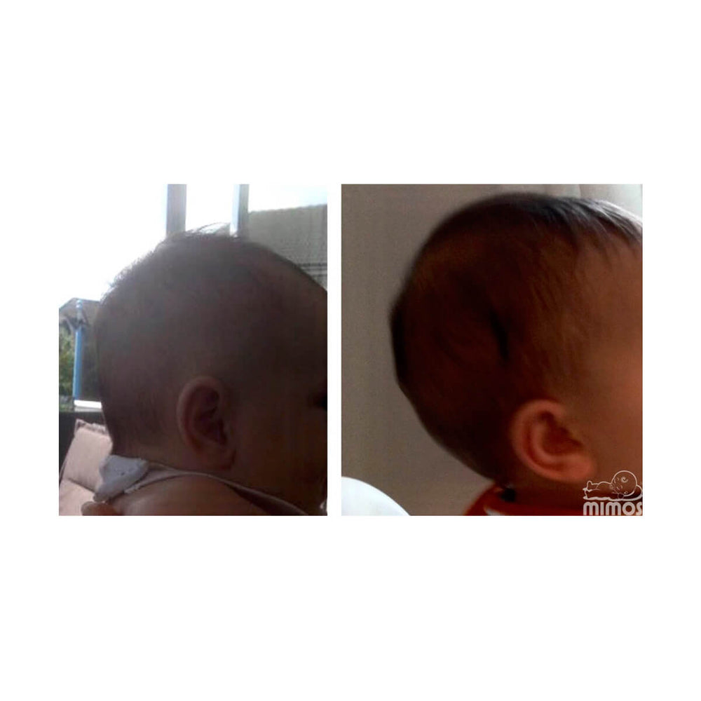 Zaležana glavica prije i poslije upotrebe Mimos jastuka
